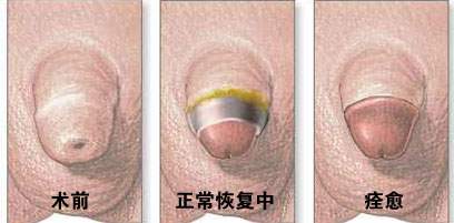 包皮手术疼吗